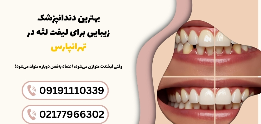 لیفت لثه در شرق تهران