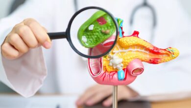 برای جلوگیری از سنگ کیسه صفرا چی بخوریم؟
